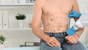 Abdominoplasty in Dehradun