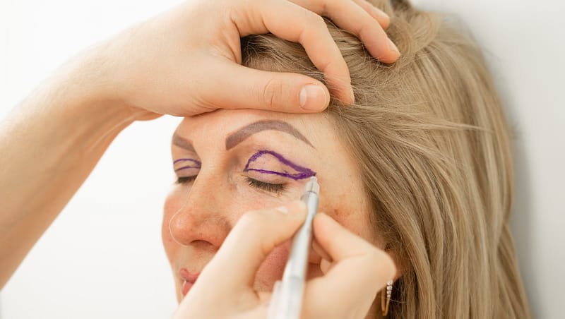 best blepharoplasty in dehradun